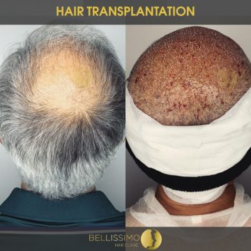 hair-transplantation-1