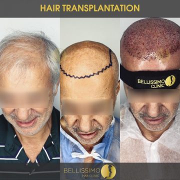 hair-transplantation-2