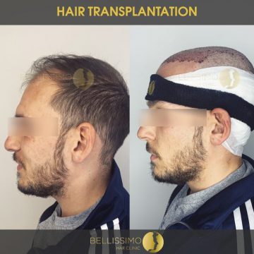 hair-transplantation-5
